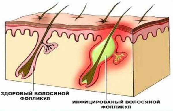 Топ-5 инфекций, которые вы можете подхватить в педикюрном салоне