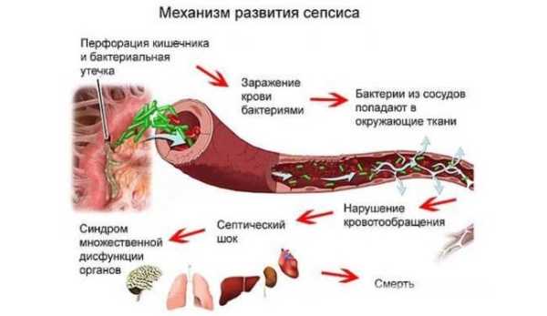 Предупреждающие знаки сепсиса