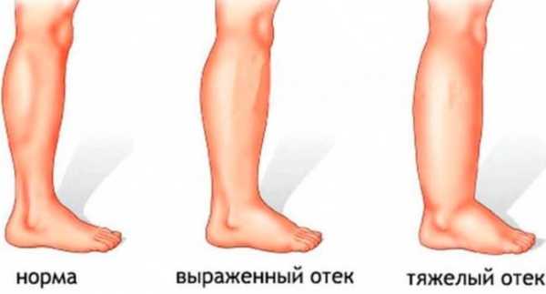 Что такое отек, как с ним справиться