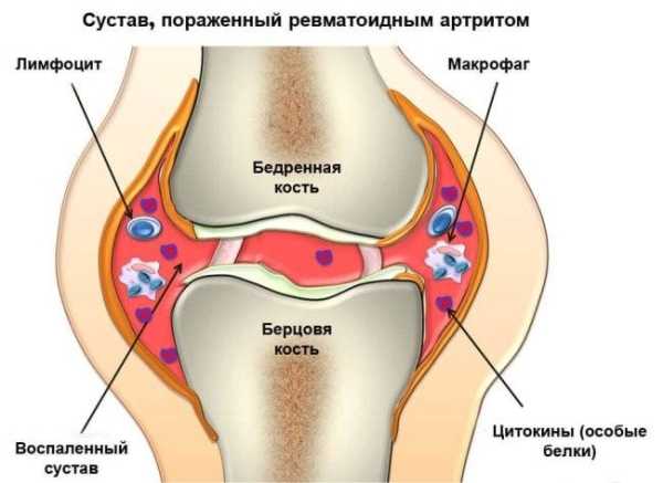 6 ранних признаков артрита, на которые необходимо обратить внимание