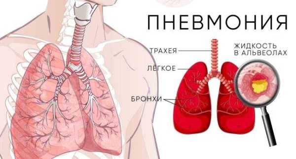 5 малоизвестных фактов о пневмонии