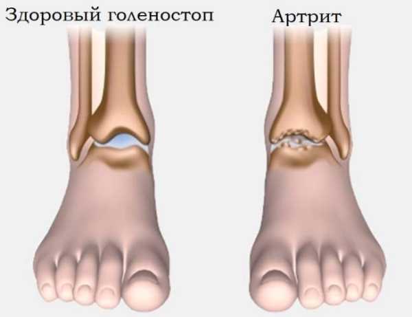 6 ранних признаков артрита, на которые необходимо обратить внимание