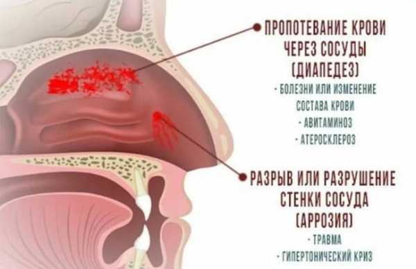 Кровотечение из носа, причины, как его предотвратить