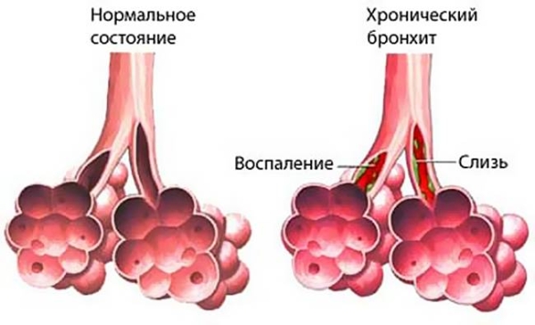 Причины затяжного кашля у взрослых