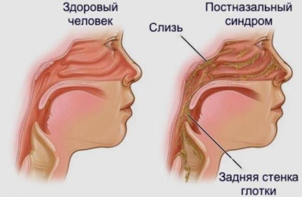 Причины затяжного кашля у взрослых