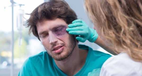 Лучшие способы лечения синяка под глазом 