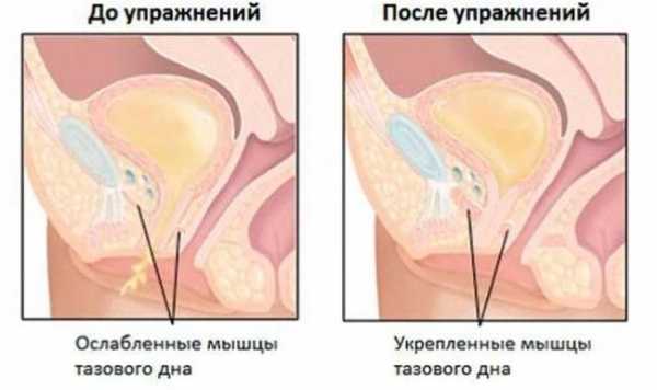 4 изменения в поведении помогут укротить недержание мочи у женщин