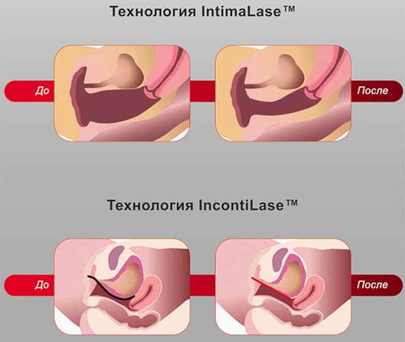 Как уменьшить влагалище, лазерное омоложение, коррекция