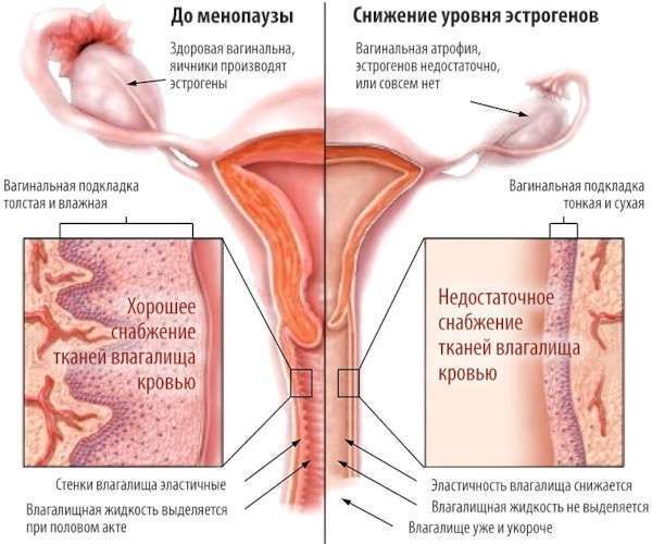 Как уменьшить влагалище, лазерное омоложение, коррекция