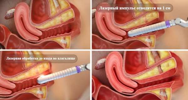 Как уменьшить влагалище, лазерное омоложение, коррекция