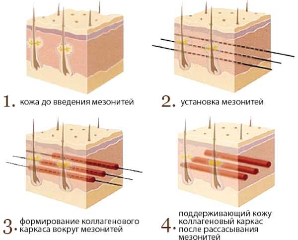 Процедура Лисьи глазки. Что это такое, как делается