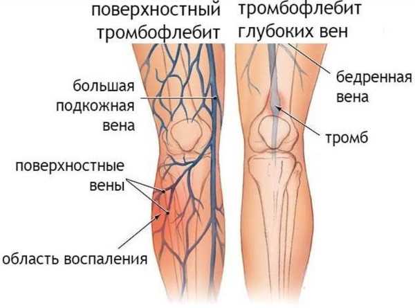 Жемчужные ванны. Что это такое, показания