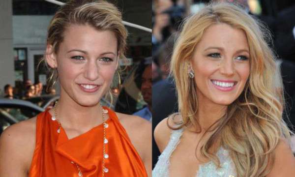 Блейк Лайвли (Blake Lively). Фото сейчас, до пластики, после