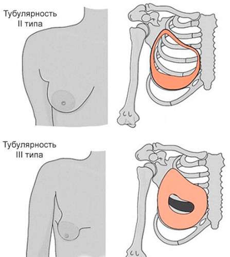 Туберозная деформация груди у женщин. Фото, как выглядит