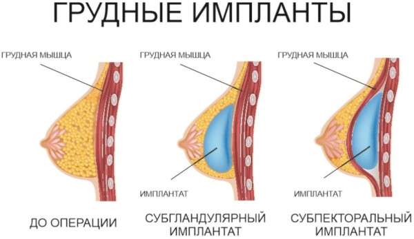 Туберозная деформация груди у женщин. Фото, как выглядит