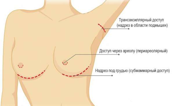 Туберозная деформация груди у женщин. Фото, как выглядит