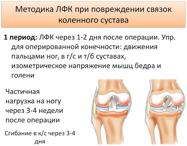 Реабилитация после пластики ПКС, ЗКС, крестообразной связки коленного сустава