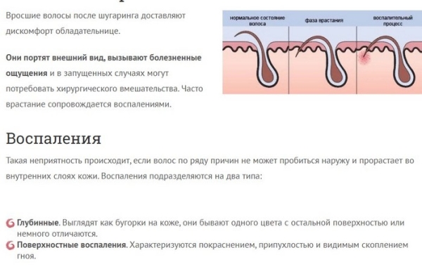 Вросшие волосы после шугаринга. Что делать, как избавиться