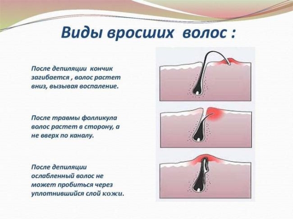 Вросшие волосы после шугаринга. Что делать, как избавиться